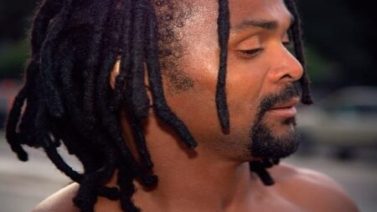 dreads dandruff